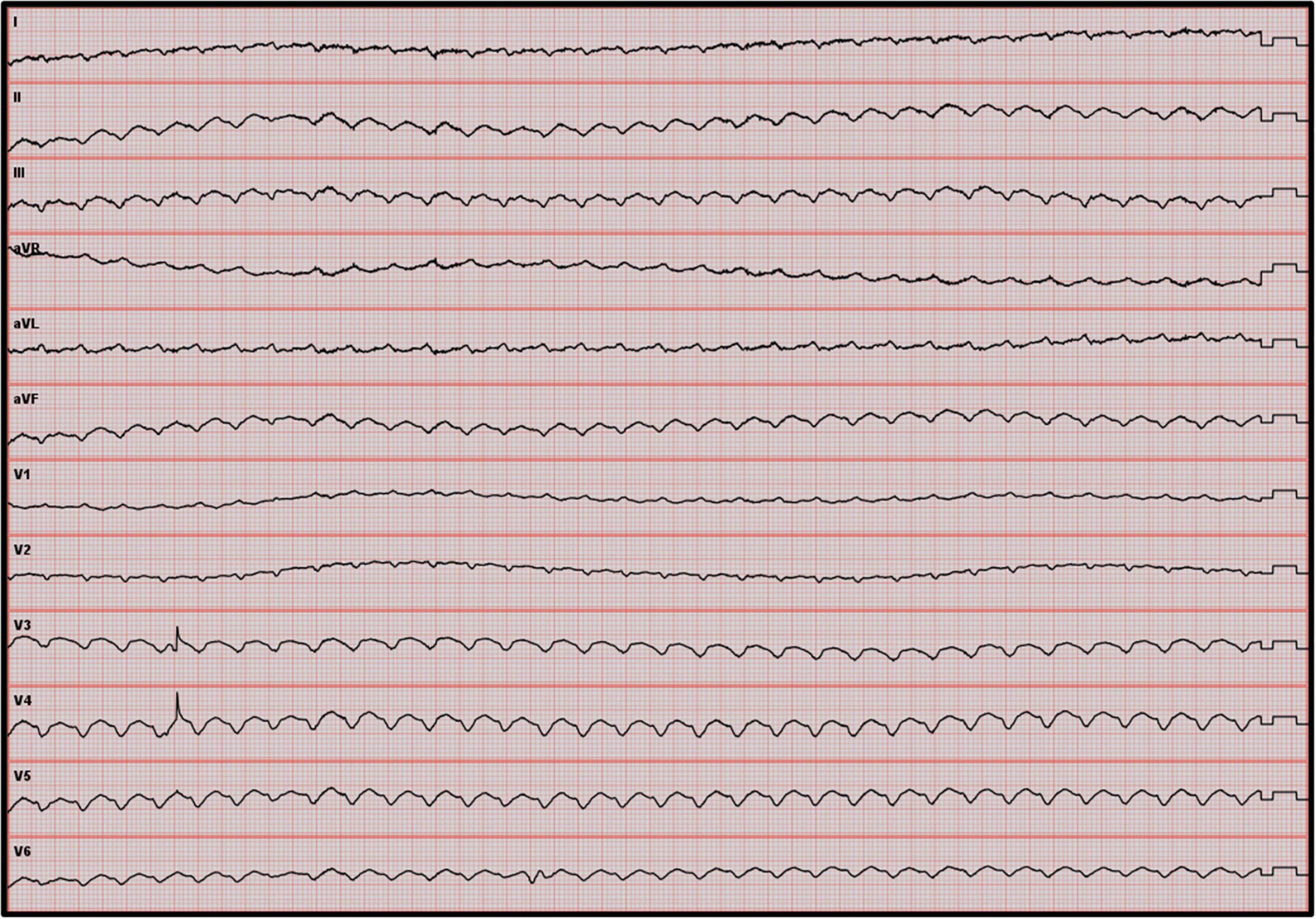 ECMELLA as a bridge to heart transplantation in refractory ventricular fibrillation: A case report